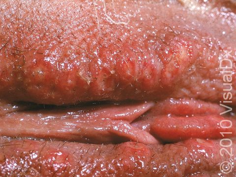 This image displays blisters and swelling on the labia due to the herpes simplex virus.