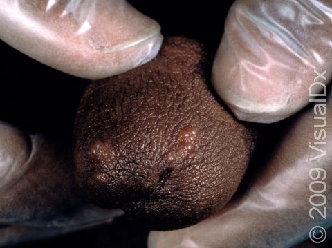 This image displays grouped blisters of fluid-filled lesions typical of early stages of herpes.