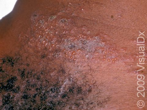 This image displays a severe outbreak of herpes in the genital region.