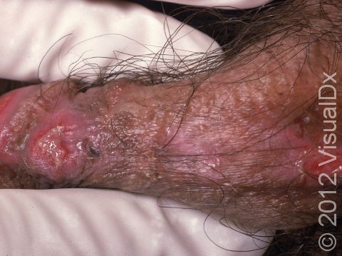This image displays large erosions and ulcers due to the herpes simplex virus on the penis on an immunocompromised patient.