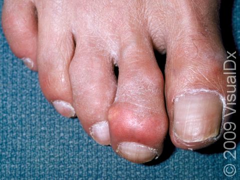This image displays an inflamed gouty tophus.