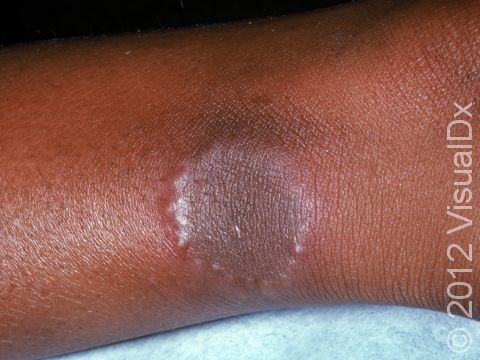 This image displays a smooth, ring-like lesion typical of granuloma annulare.