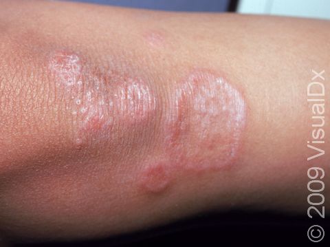 Granuloma annulare has non-scaling, round, ring-like skin lesions.