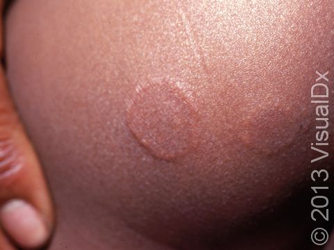 This ring-like lesion is smooth and without scaling, typical of granuloma annulare.