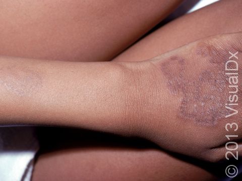 This image displays the raised edge typical of granuloma annulare as well as multiple lesions, combining the ring shapes.