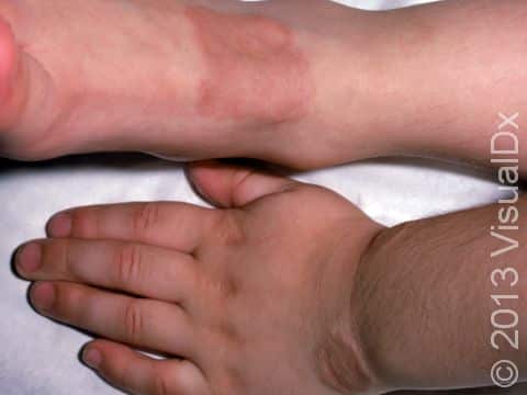 This image displays the tops of a hand and foot affected by granuloma annulare.