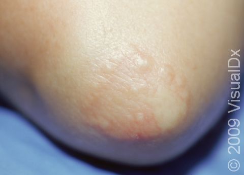 This image displays granuloma annulare on the elbow.