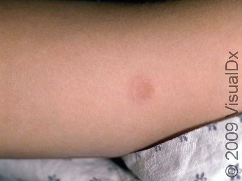 This image displays a smooth, light pink, ring-like, slightly elevated lesion typical of granuloma annulare.