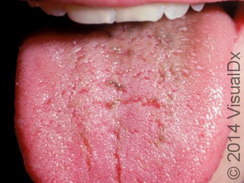 This image displays back, brown, and gray papillae typical of hairy tongue.