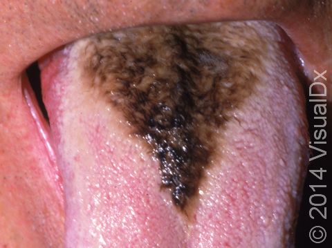 This image displays hairy tongue, where the taste buds are longer than normal, giving a dark, hairy look to the back of the tongue.