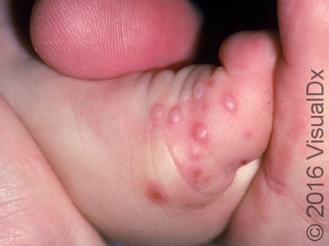 This image displays small blisters typical of hand, foot, and mouth disease.