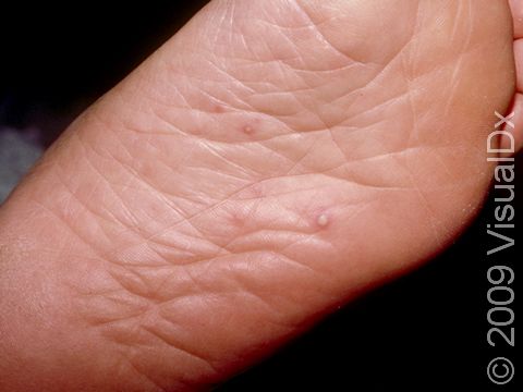 This image displays small, fluid-filled blisters on the foot typical of hand, foot, and mouth disease.