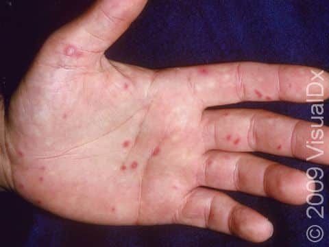 This image displays small blisters on the palm and fingers typical of hand, foot, and mouth disease.