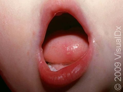 There are usually just a few blisters in the mouth in hand, foot, and mouth disease.