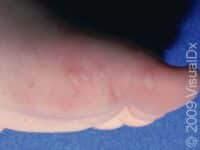 Hand-Foot-and-Mouth Disease