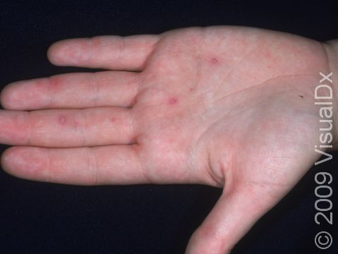 There are often few, small blisters in people with hand, foot, and mouth disease.