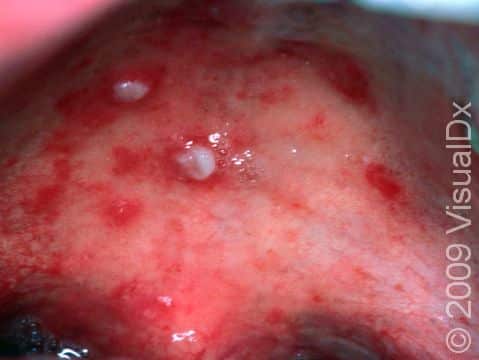 There are two small blisters on the hard palate, typical of hand, foot, and mouth disease, as well as several red spots, which may become blisters or were left after blisters broke.
