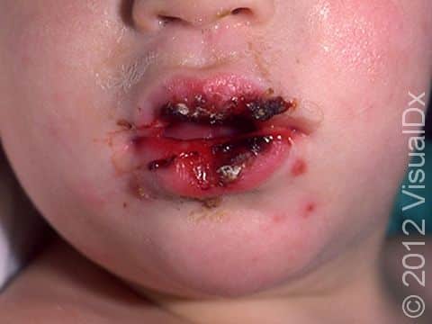 Erosions and blood-filled blisters and crusts are typical with primary herpes simplex infection as with this child.