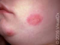 Herpes Simplex Virus (HSV)