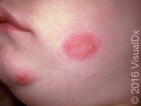 This image displays grouped blisters within an inflamed area of skin typical of herpes simplex.