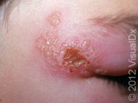 Herpes Simplex Virus (HSV) – Child