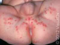 Herpes Simplex Virus (HSV)
