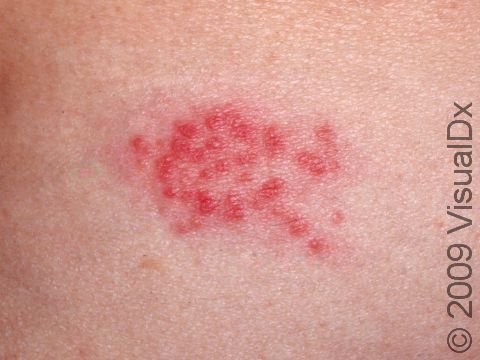 This image displays a grouping of skin lesions typical of herpes.
