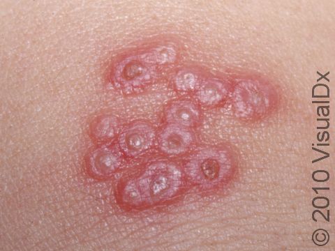 The small blisters (vesicles) of herpes virus infections often have surrounding redness.