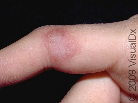 The herpes simplex virus infection on the finger is known as herpetic whitlow. Grouped, fluid-filled, or pus-filled blisters are typical and usually itch and/or are painful.
