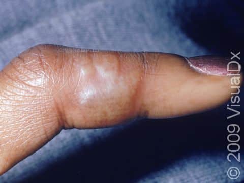 This image displays blisters on a finger typical of a herpes simplex infection.