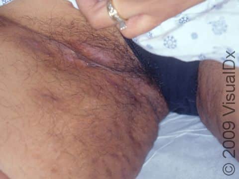 The thigh and the skin fold in the groin are typical locations for the cysts of hidradenitis suppurativa.