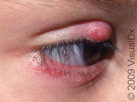A chalazion / stye can occur at the eyelid edge.