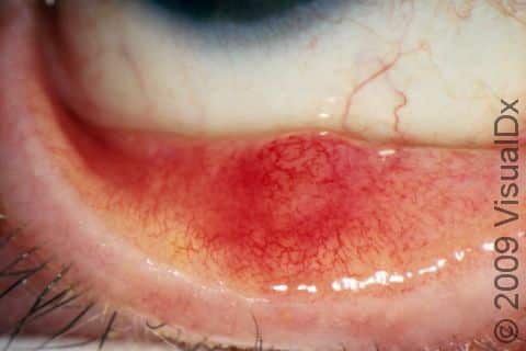An external stye (hordeolum) will often cause blepharitis (inflammation and redness of the inner eyelid).