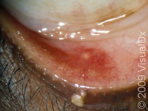 A cheese-like (sebaceous) discharge from the chalazion is often seen, especially after applying hot compresses.