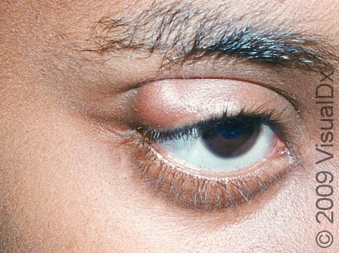 A chalazion / stye can occur on the outer angle of the eyelid.