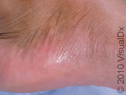 Profuse sweating localized to a common area: the sole of the foot.