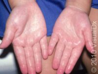 Excessive Sweating (Hyperhidrosis) – Adult