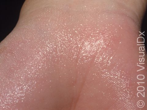 Close-up view of excessive sweating affecting the palm.
