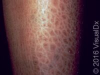 Scaly Skin (Ichthyosis Vulgaris)