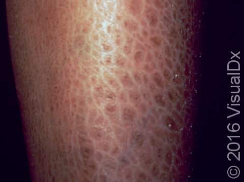 This image displays the fish-scale appearance typical of ichthyosis.