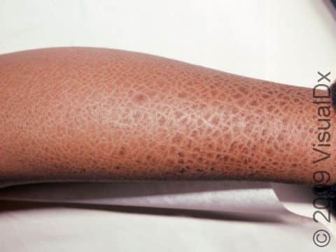 This image displays the fish-scale-like skin typical of ichthyosis.
