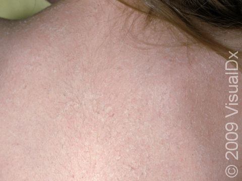 This image displays rough, dry skin on an extensive area of the trunk typical of ichthyosis.