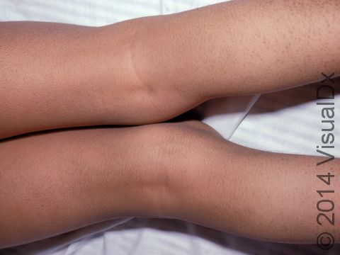 This image displays the bends of the legs, which are usually not affected with ichthyosis vulgaris.