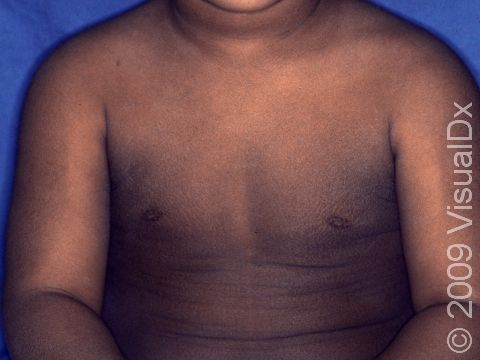 In ichthyosis vulgaris, there is a dry, flaky skin surface, as displayed in this image.
