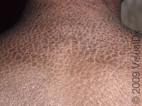 This image displays ichthyosis vulgaris, which often runs in families.
