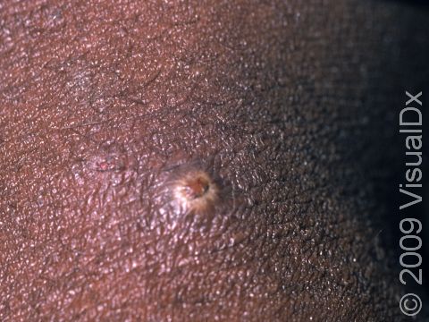 This image displays a small pus-filled lesion that is developing a crust.