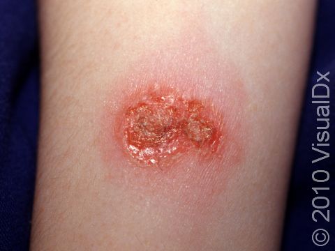This image displays a lesion with a varnish-like crust typical of impetigo.