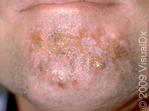 This image displays honey-colored crusts in the beard area, typical of impetigo.