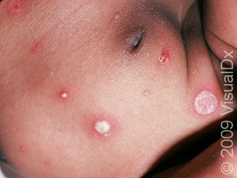 This image displays an unusual case of impetigo; typically, the pus-filled lesions break so easily they leave eroded skin.