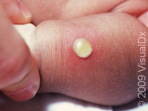 This image displays a newborn with pus-filled blister typical of impetigo.